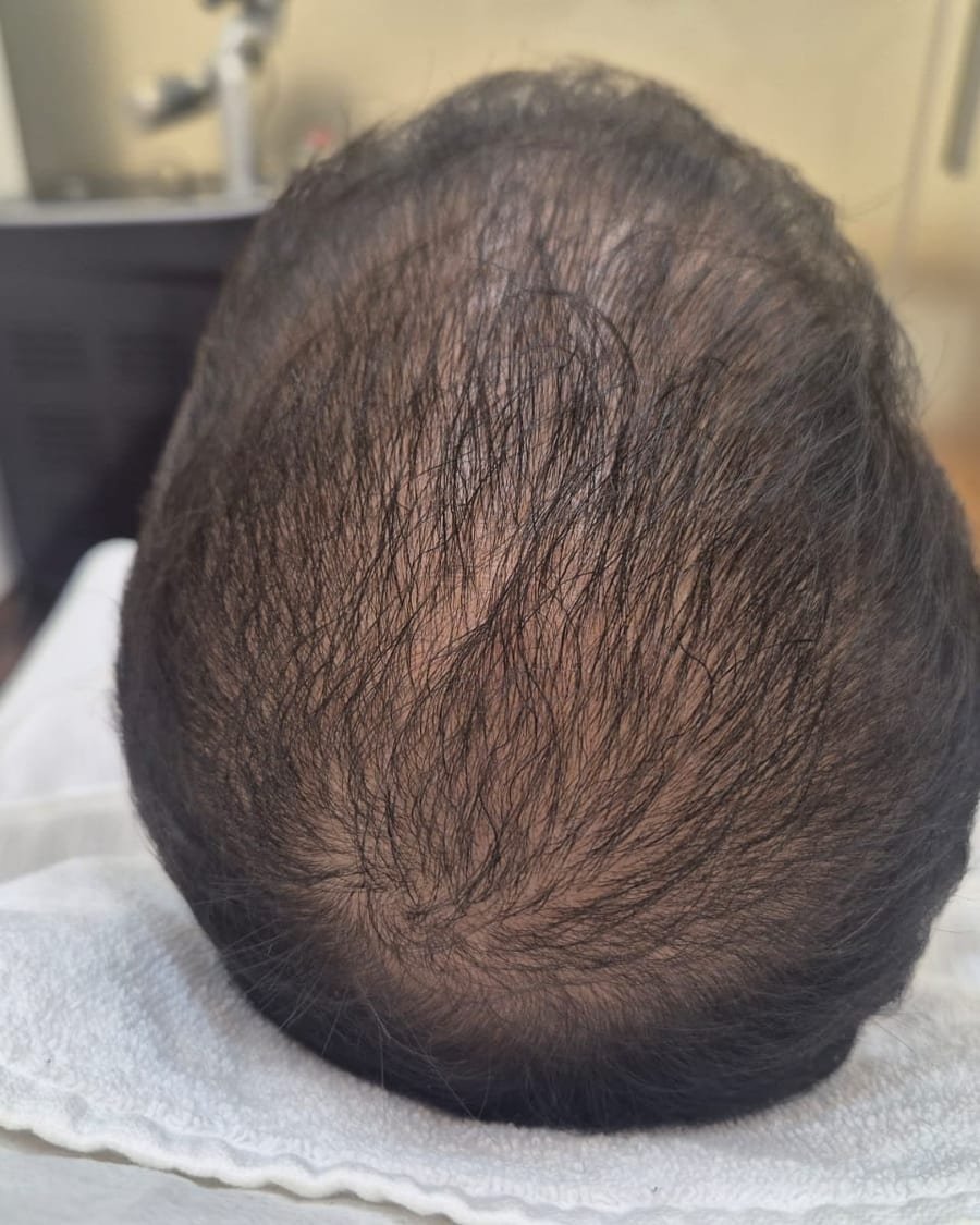 Real patient scalp hair growth and follicle reactivation after clinical PRP therapy at ABSOLUT AURAA Colaba