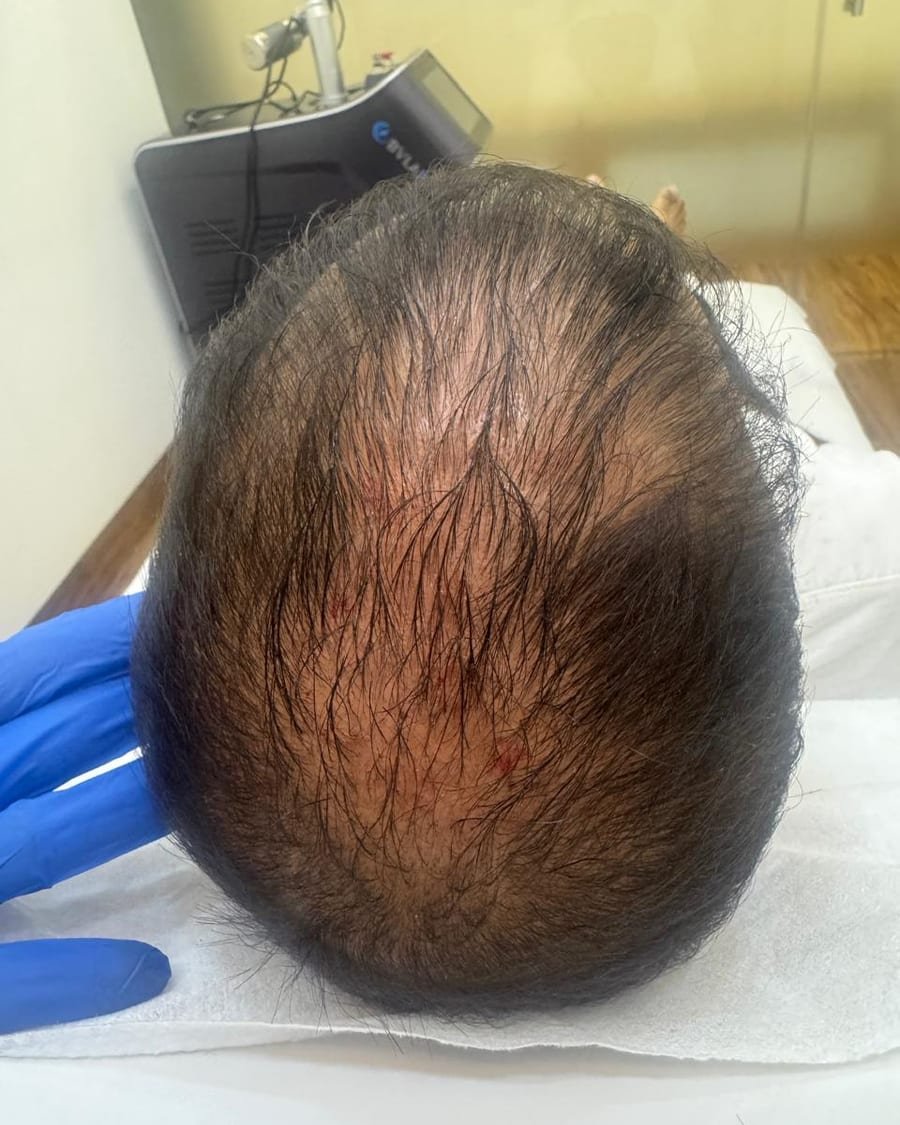 Real clinic patient crown hair thinning prior to PRP therapy at ABSOLUT AURAA Colaba